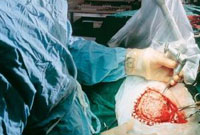 Doctors implant skull bone into patient’s leg to remove brain tumor