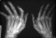 Cancer risks detailed for rheumatoid arthritis drugs