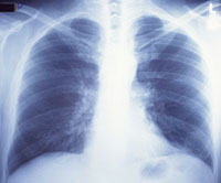 X-rays may cause breast cancer