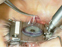 FDA Engages In Study on Laser Surgery Effects
