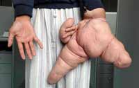 Elephantiasis and progeria are just a few of world’s most horrendous diseases