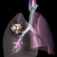 Genetic Characteristics May be Key to Deciding Right Lung Cancer Treatments