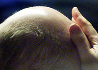 Full scalp transplants from cadavers may cure baldness in future