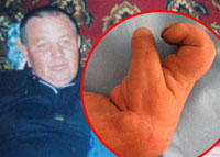 Doctors reattach man's hand after he chops it off