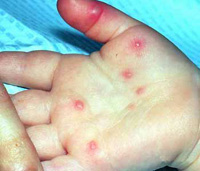 Hand, foot and mouth disease in Malaysia: 9 dead