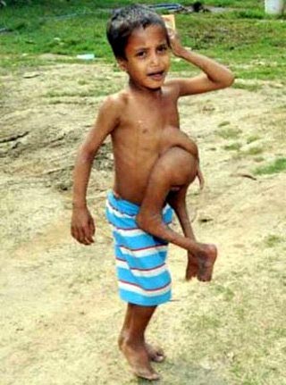 Boy Born with Parasite Brother Growing from His Stomach Finally Happy