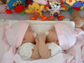 Two-year-old conjoined twin girls undergo surgery