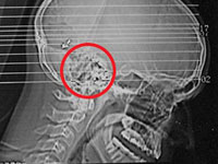 Man survives after bullet crosses his brain twice
