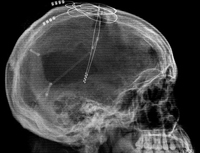 Doctors bring man out of 6-years coma after severe brain injury