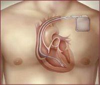 US government wonders about recall of Medtronic Inc.'s heart defibrillator wires