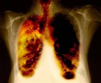 Blood test may help to detect lung caner