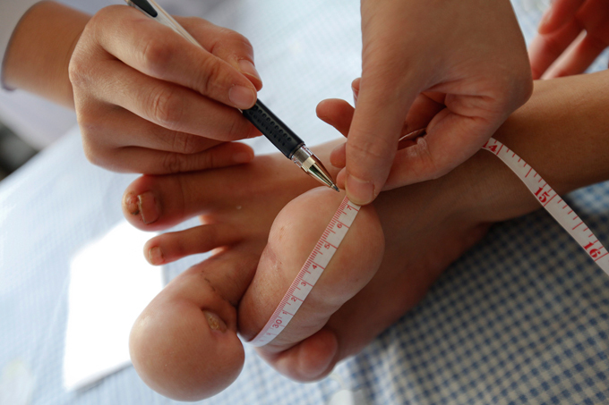 Hobbit boy with giant feet to receive surgery