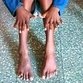 Ten-year-old Indian boy has 25 fingers