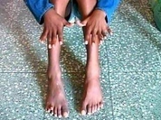 Ten-year-old Indian boy has 25 fingers