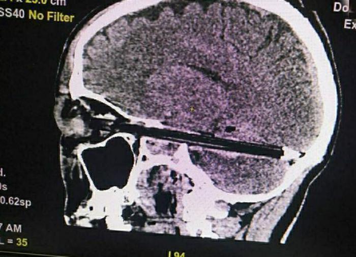 Prison inmate who pierced his brain with a pen, dies at hospital