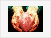 Harvesting organs from dead bodies considered immoral, although it is essential