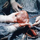 Saint Petersburg Surgeons Perform Unique Heart Transplantation Surgery