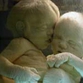 Moderm surgery gives normal life to Siamese twins