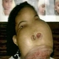 US surgeons remove huge tumor off Haitian girl's face
