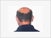 Gene discovered by Russian scientists may help cure baldness