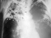 The Killer: Multi-resistant Tuberculosis