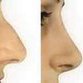 Georgians rush to plastic surgeons for Western noses