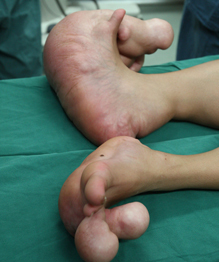 Hobbit boy with giant feet to receive surgery